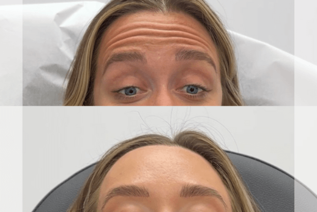 Botox in Tampa