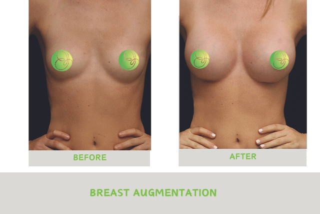 Breast Augmentation at Tampa’s Top Plastic Surgeons