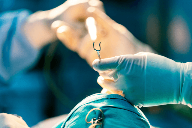 Hernia Repair in Tampa