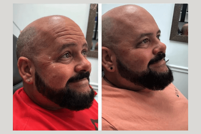 Non-Surgical Cosmetic Procedures for Men