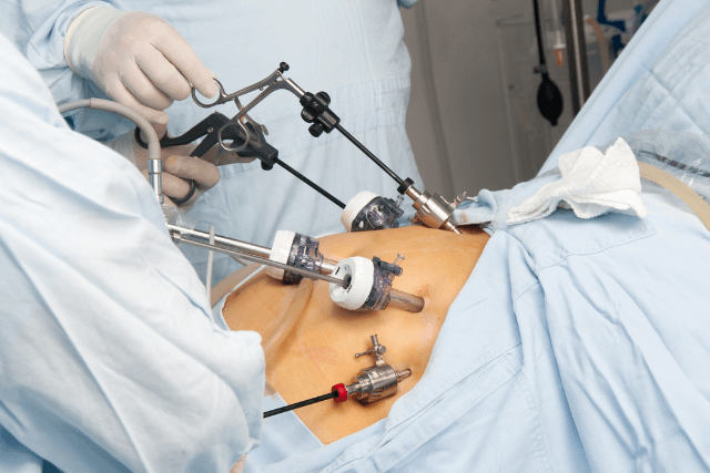 Gastric Sleeve vs. Bypass