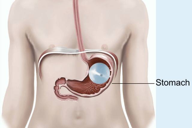 Non-Surgical Weight Loss at IBI Clinic Tampa: Safe and Effective Options
