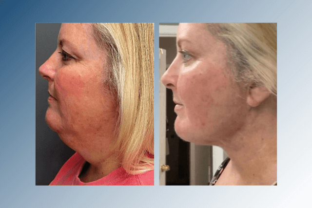 What Is FaceTite and How It Works