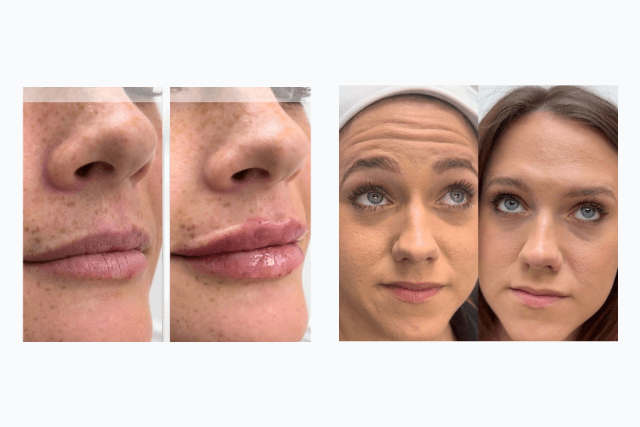 Botox vs Fillers