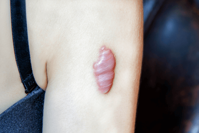 Treatment for Keloids in Tampa
