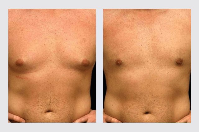 Male Breast Reduction Before and After