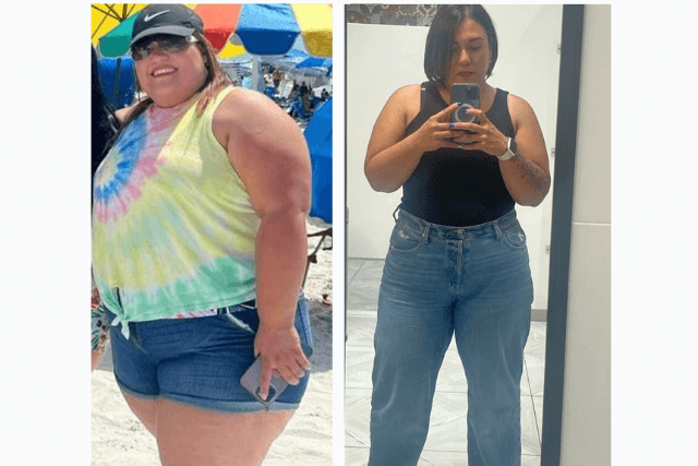 Before and After Picture of a patient after Overcoming Fear of Bariatric Surgery