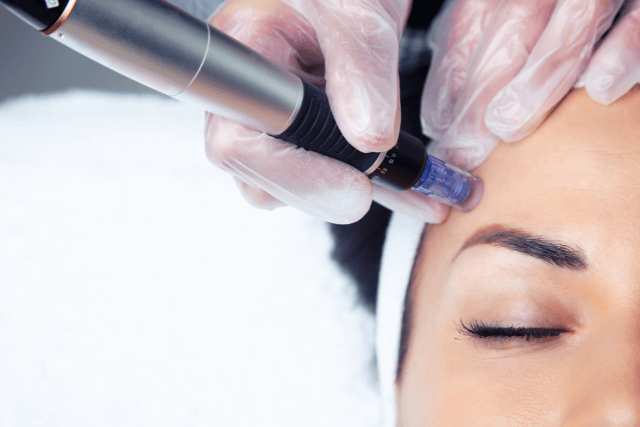 Microneedling