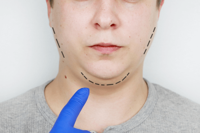 Men's Facelift Trend 2025