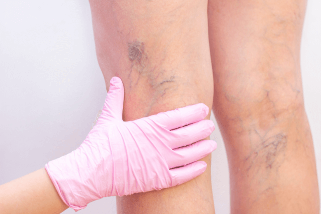 What Causes Varicose Veins